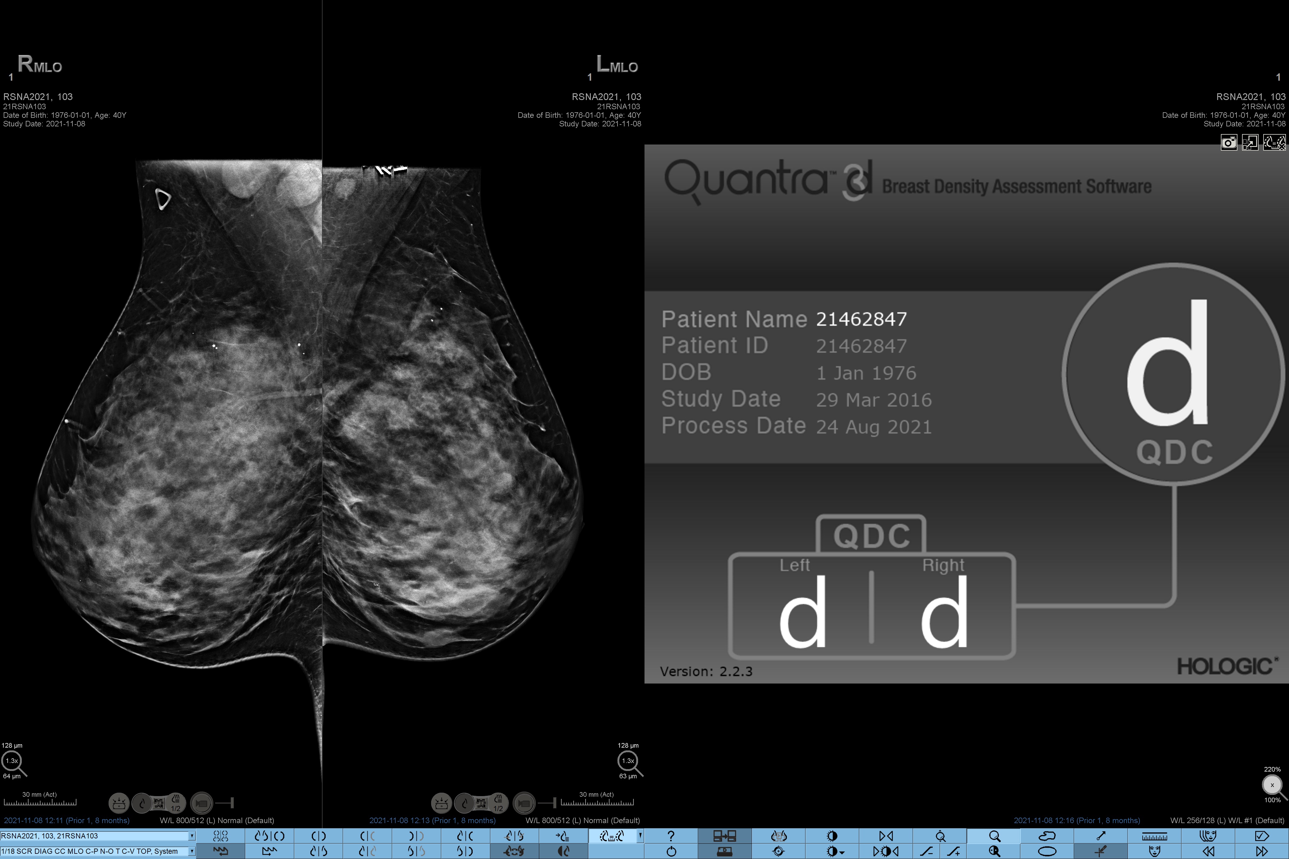 Quantra® 2.2 | Breast Density Assessment Software | Hologic